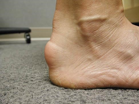 Achilles Tendonitis - Understanding Overuse Injuries