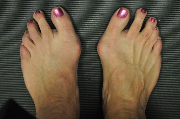 Bunions - A Deformity That Requires Attention