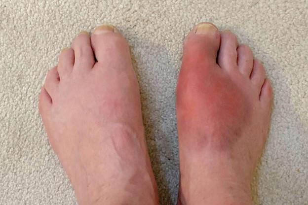 Gout - A Form of Arthritis Affecting the Feet