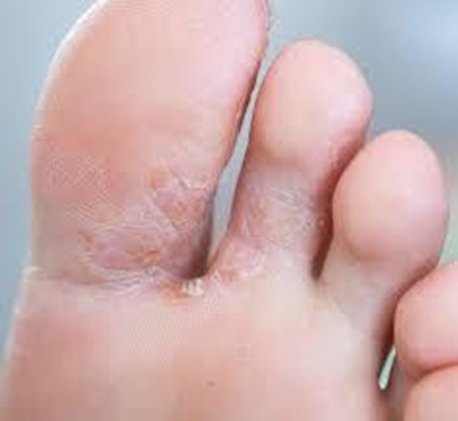 Athlete's Foot - A Common Fungal Infection