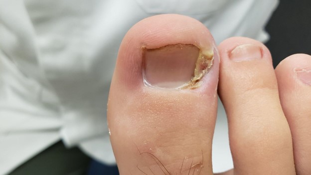 Ingrown Toenails - A Painful, Yet Preventable Issue